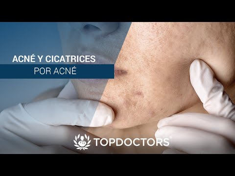 Acné y Cicatrices por Acné