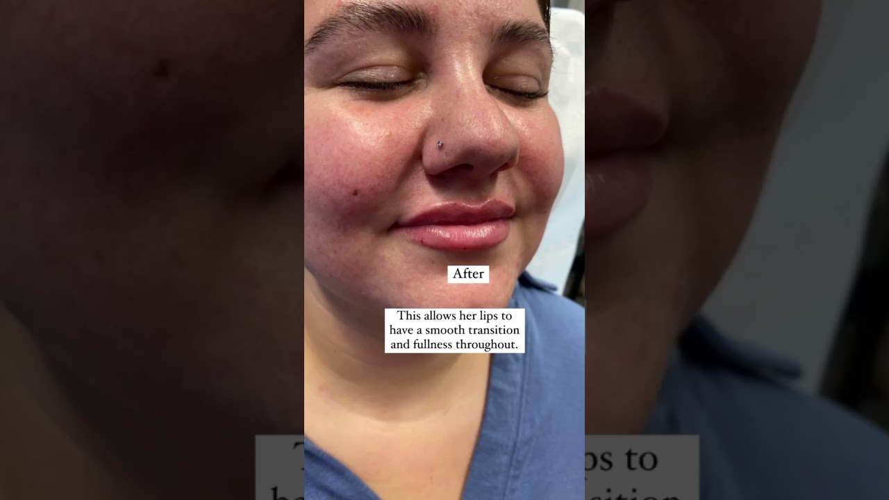 M shaped lips - How to fill correctly with lip filler