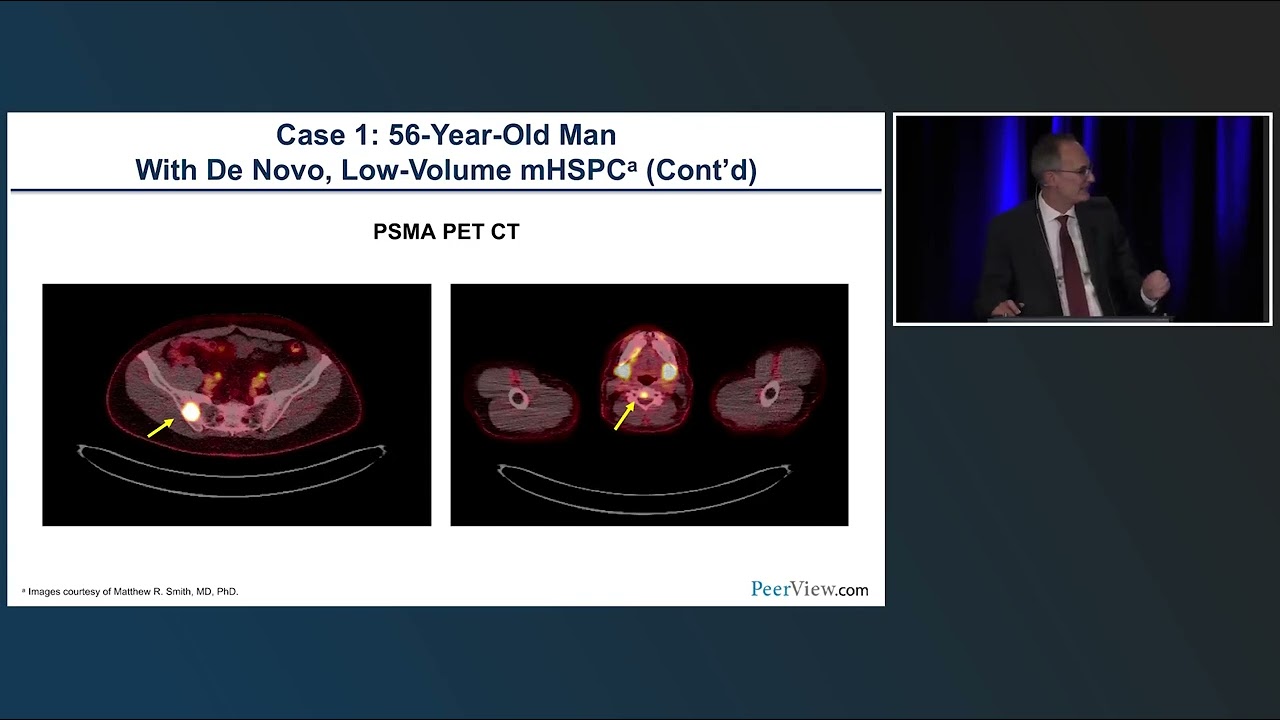 Castration 'An Unfortunate Term' for Key Part of Prostate Cancer ...