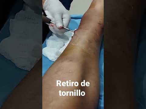 Retiro de tornillo de compresión ósea de tibia.