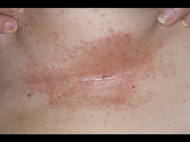Dark rash under breasts