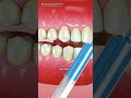 Have you ever wondered how teeth whitening actually works?#TeethWhitening #DentalCare