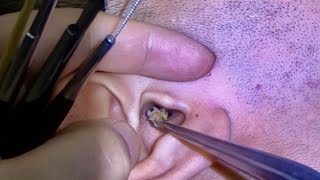 耳掃除 귀 청소 Ear Cleaning #335