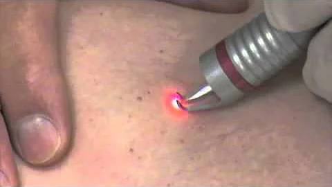 Ron Bush, M.D. - Treating Spider Veins with diode ...