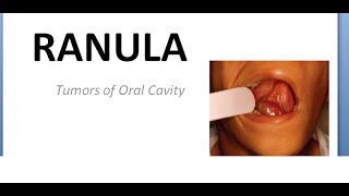 ENT Ranula Tumors of oral cavity Below tongue swelling mass round cyst plunging sublingual salivary screenshot 4