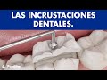 Incrustaciones dentales - Restauración de muelas ©