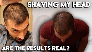 Rogaine/Minoxidil Month 8 Results | SHAVING MY HEAD!