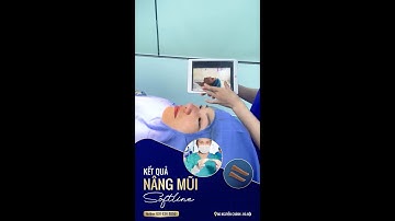 KẾT QUẢ SAU SỬA MŨI SOFTLINE - ĐỘC QUYỀN TẠI DR VŨ QUANG