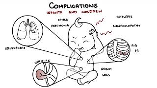 What is Pertussis and whooping cough? - Bordetella pertussis symptoms, pathophysiology and treatment by Armando Hasudungan 37,270 views 4 months ago 10 minutes, 43 seconds