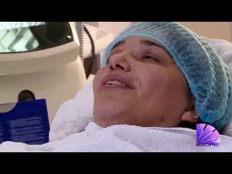 ცხვირ-ტუჩის ნაოჭის ამოვსება, კარბონის ლაზერული პილინგი