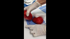 Explant Srugery, Capsular Contracture, Ruptured Breast Implants