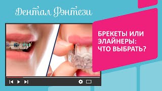 Брекеты или элайнеры🤔 Что выбрать❓