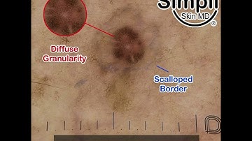 Lichenoid Keratosis Dermoscopy