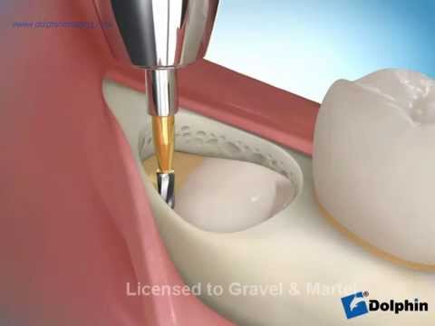 Extraction des dents de sagesse à Aubagne - Centre Oroface