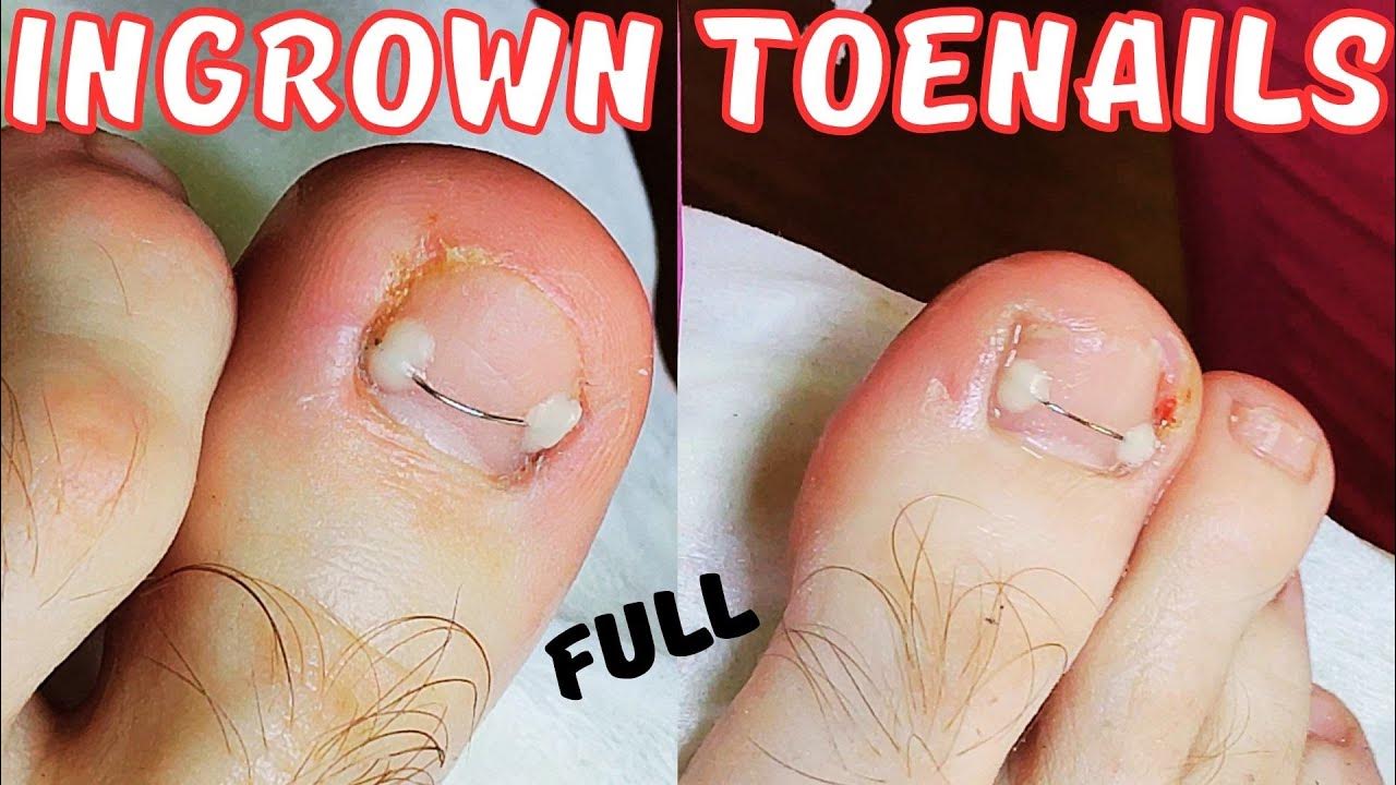 How to get rid of ingrown toenail forever. YouTube