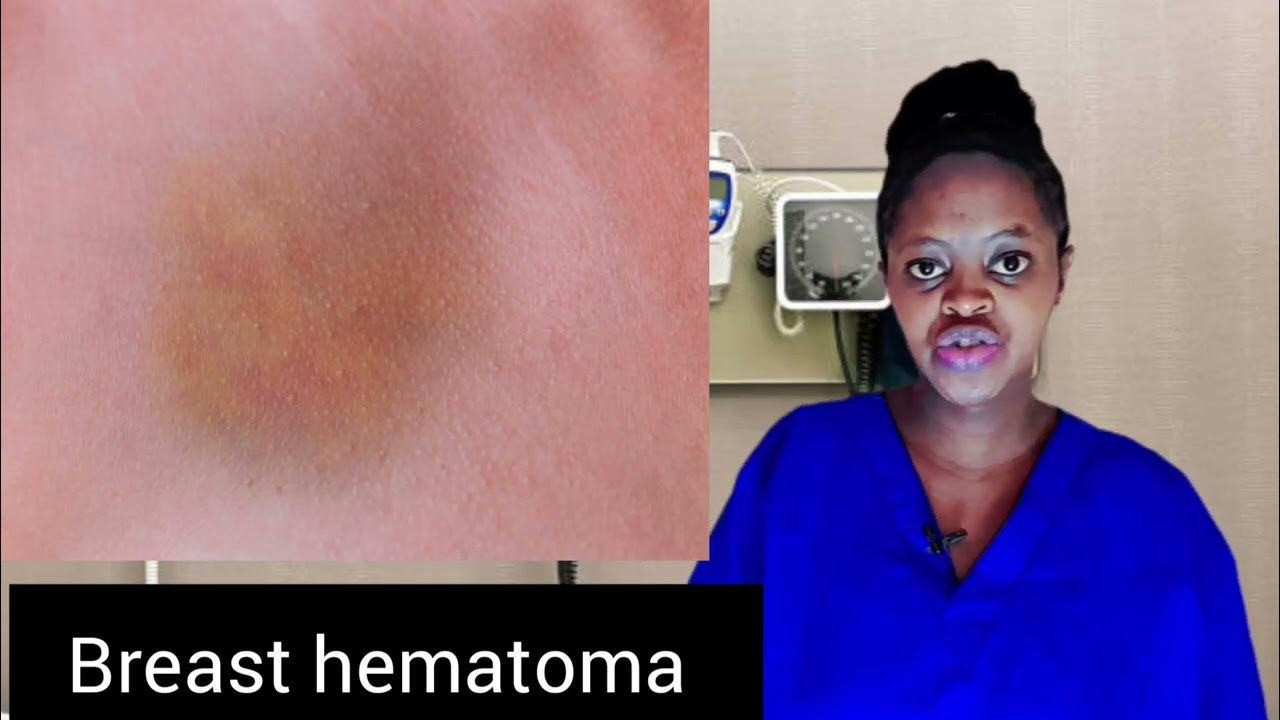breast-hematomas-causes-signs-and-symptoms-treatment-youtube