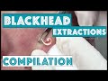 Gross! This Blackhead Removal Process Was Viewed Over 4 Million Times! (VIDEO)