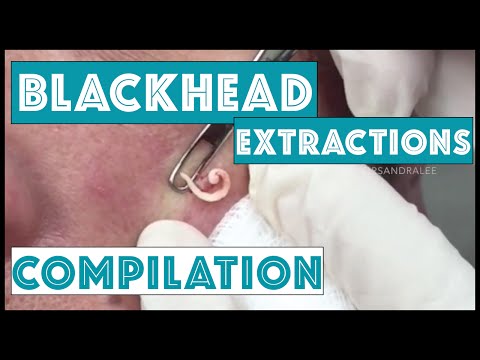 Long And Satisfying Blackhead Extractions: A Dr Pimple Popper Compilation