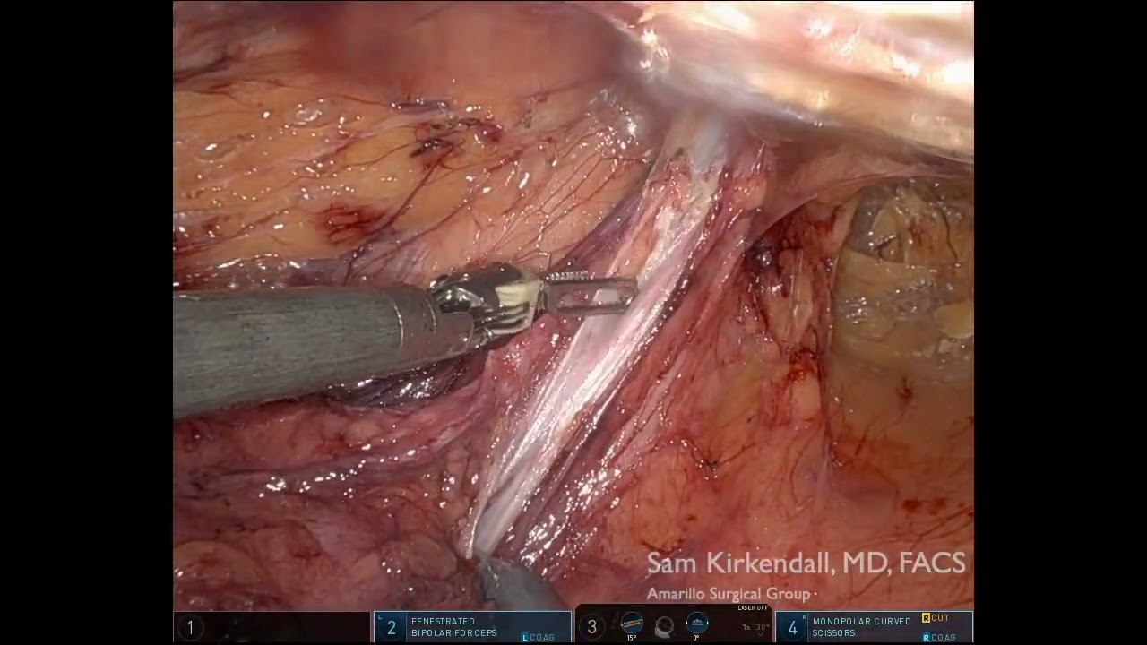 Patient Education—Robotic TAPP Left Inguinal Hernia Repair