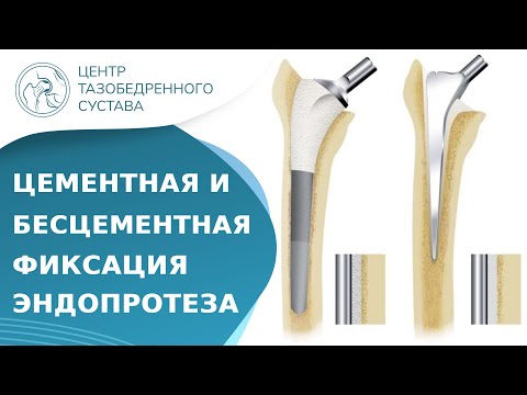 🦿 В чем отличие цементной фиксации от бесцементной? Цементное и бесцементное эндопротезирование. 18+