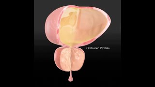 Surgical treatment of enlarged prostate
