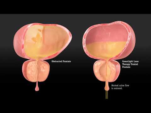 green laser prostate