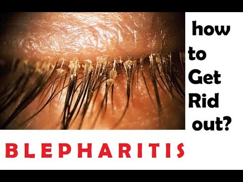 blepharitis treatment at home in hindi