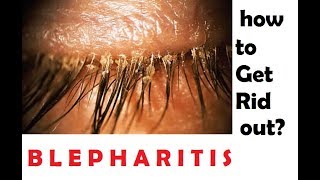 what is blepharitis? How to get rid out of this? (hindi)
