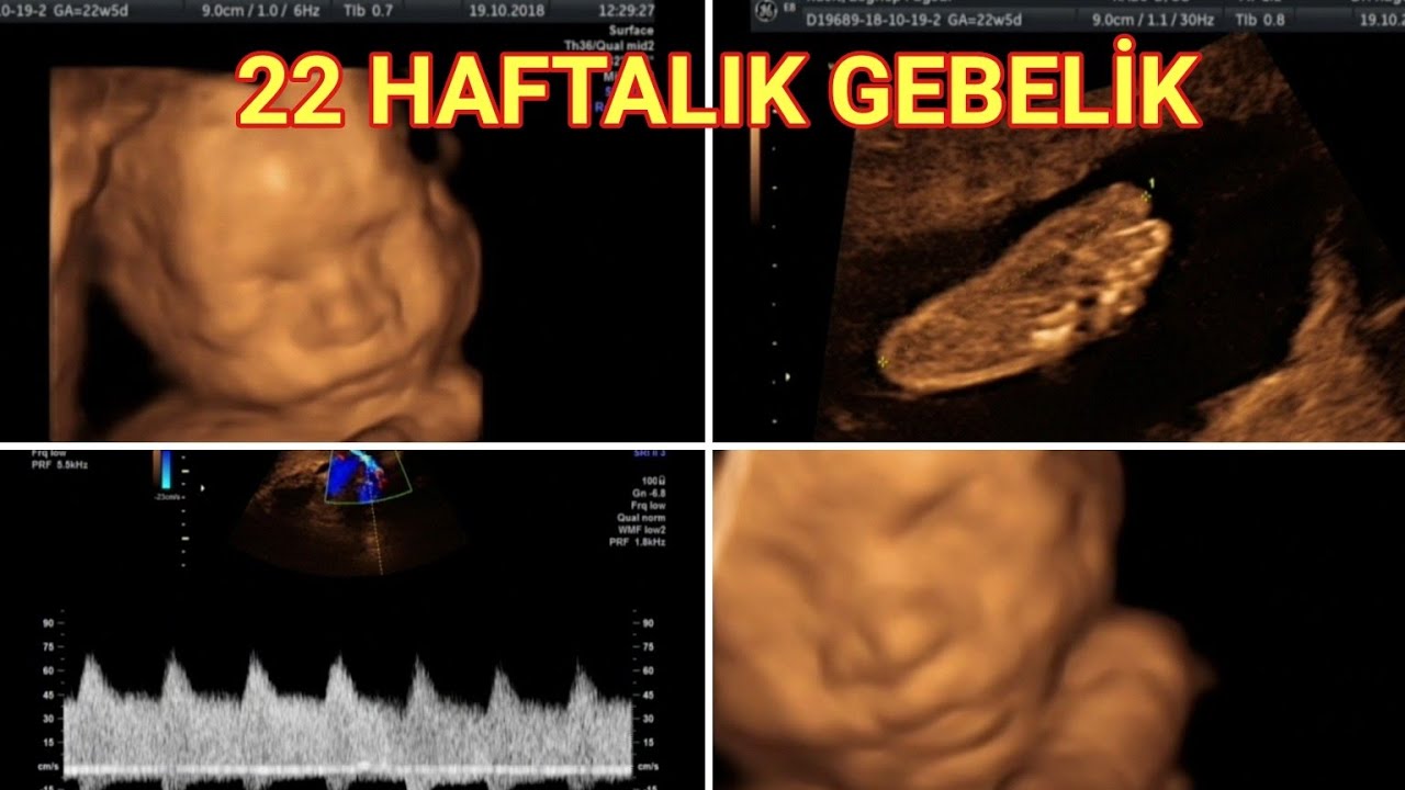 22 haftalik 5 aylik hamilelikte bebegin ultrasonografi ve renkli doppler goruntuleri aciklamali youtube