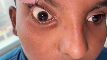 Kayser-Fleischer (KF) ring in Wilson’s Disease