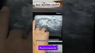 มือชา รักษาไม่ผ่า อย่างไร?