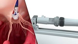 PASCAL Precision System – Implantation of the device in the mitral and tricuspid valves | Animation