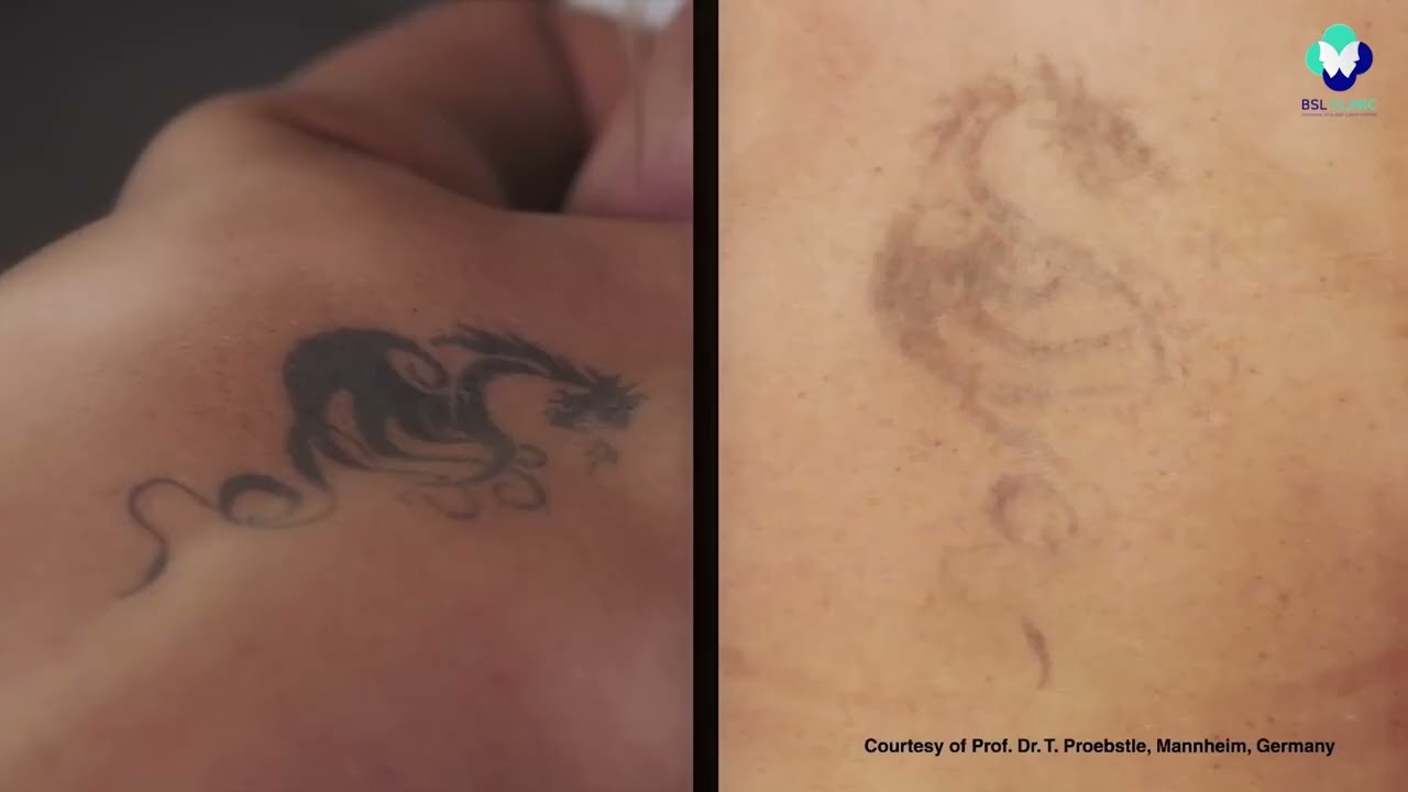 Laser Tattoo Removal  Dermatologist In Tulsa OK  Dermatology and Laser  Center of Oklahoma