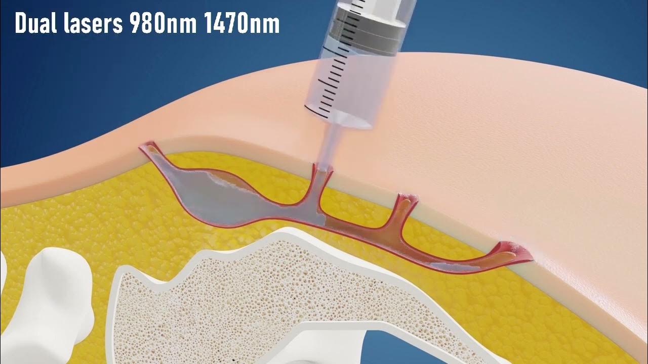 Sinus laser ablation of pilonidal cyst silac ibi healthcare institute