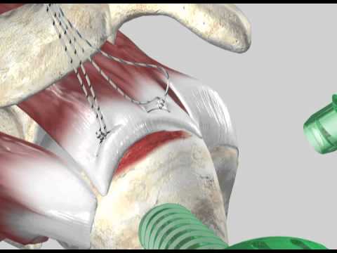 FOOTPRINT* PK Suture Anchor Technique