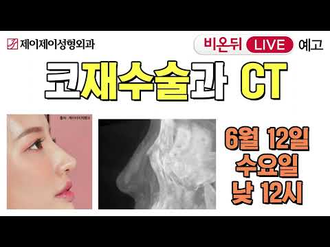 [비온뒤 예고] 코 재수술과 CT - 유튜브 의학채널 비온뒤 (제이제이성형외과)