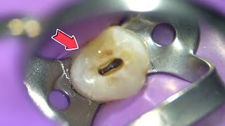 LIVE: Root Canal Procedure under the Microscope w/ Specialist by Smile Influencers 1,052,043 views 1 year ago 6 minutes, 37 seconds