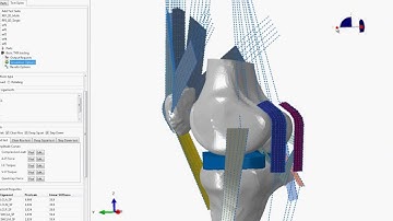 SIMULIA Abaqus Knee Simulation