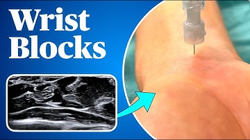 Wrist Blocks (Landmark AND ultrasound guided approaches!)