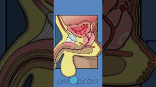 PreOp® 🚨 Prostate Health: Biopsy Explained #preop #shorts #health 🏥