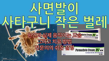 #사면발이 #사면발니 사타구니에 기어다니는 아주 작은 벌레들 - 성 접촉으로 감염 가능, 치료 방법 설명 by 가정의학과 전문의