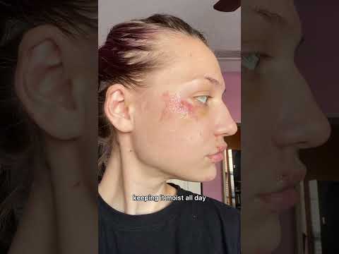 Videó: 3 egyszerű módszer az arcán lévő karcolások gyógyítására