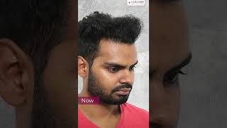 1805 Grafts. One Powerful Transformation | Apoorv Jha’s Hair Transplant Journey