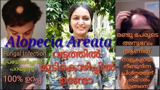 Alopecia Areata/വട്ടത്തിൽ മുടി കൊഴിയുന്നത് മാറ്റാൻ മലയാളം /Hair Fall Malayalam
