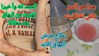 البهاق الجديد علاج البهاق: الأعراض،