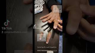 علاج الاصبع المقطوع باستخدام اصابع اليد السيليكون الصناعية الآن في الأردن. #finger #rehabilitation