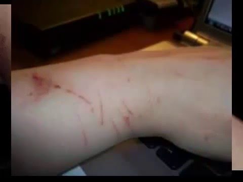 hematomas inexplicables en los brazos