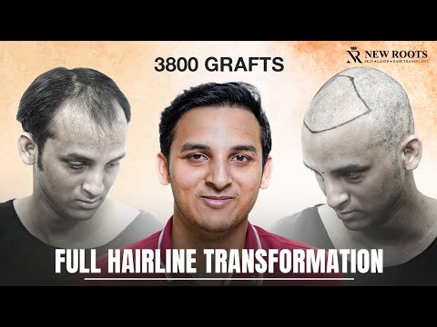 Natural Hairline After Hair Transplant 😍 | 3800 Grafts | Hair Transplant Cost in Kolkata | New Roots