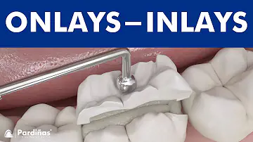 Como é feito onlay?