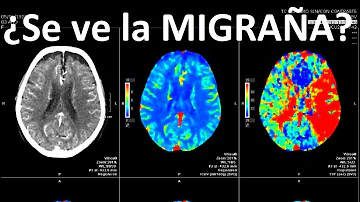 ¿Aparecen las migrañas en la resonancia magnética cerebral?